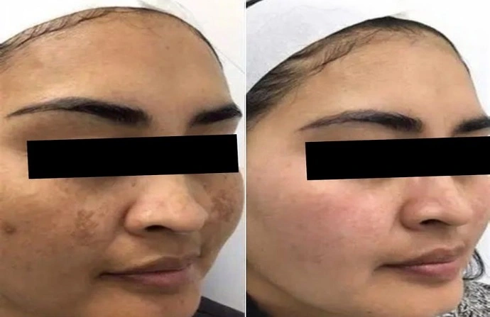 glutathione iv results before and after Glutathione main image 0