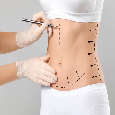 Circumferential Abdominoplasty