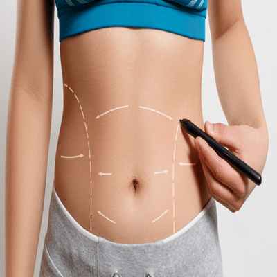 Laser Liposuction in Dubai