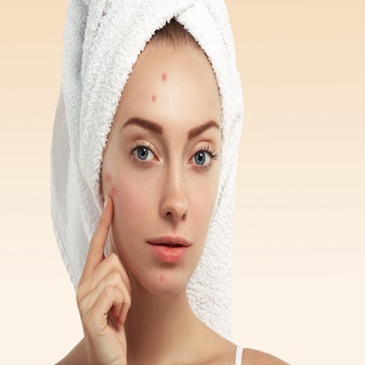 Pimples treatment in Dubai