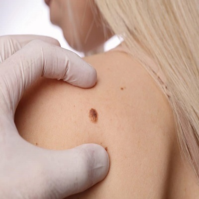 Birthmark removal in Dubai