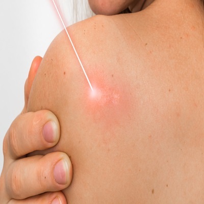 Laser wart removal in Dubai