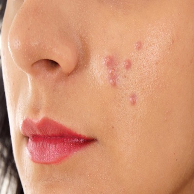 Pimples treatment in Dubai